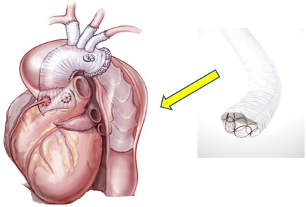 オープンステントグラフト内挿と併用した人工血管置換術