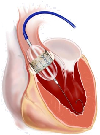 経大腿動脈アプローチ