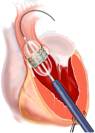 b)経心尖部アプローチ