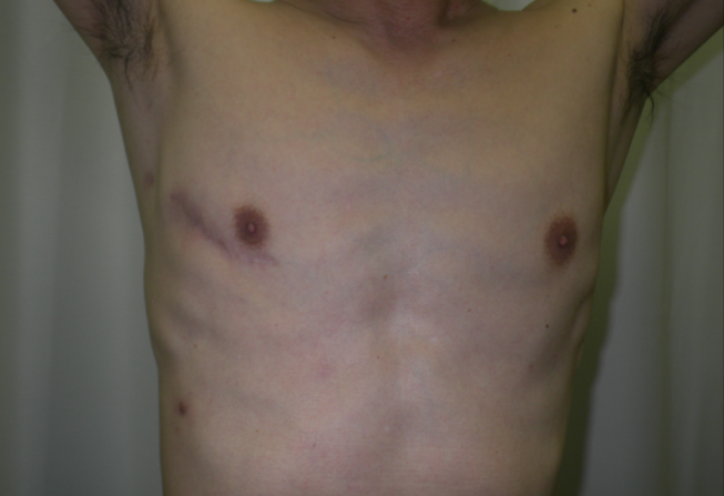 b)右小肋間開胸創部写真(8 cm切開)