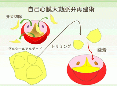 a)自己心膜を使用した大動脈弁再建術