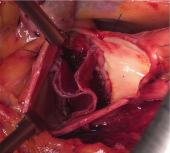 b)自己心膜大動脈弁再建後の写真