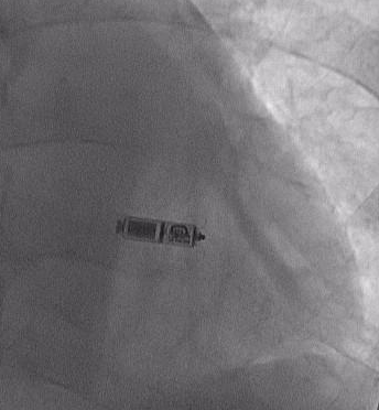 リードレスペースメーカ