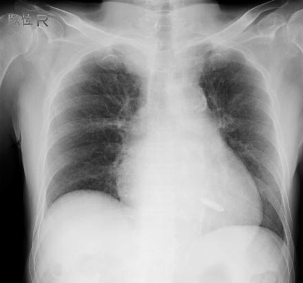 リードレスペースメーカ