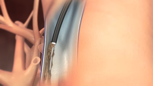 経静脈電極抜去術