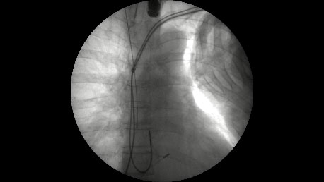 経静脈電極抜去術