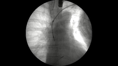 経静脈電極抜去術
