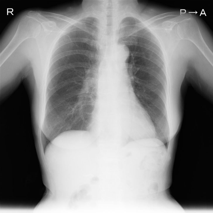経静脈電極抜去術