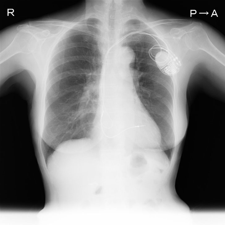 経静脈電極抜去術