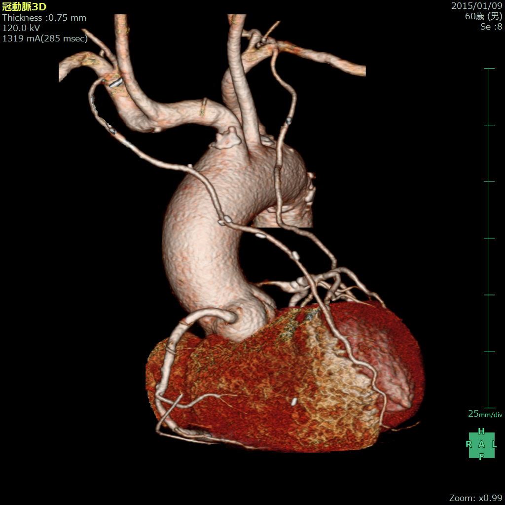 （図5）両側内胸動脈グラフトを用いた心拍動下冠動脈バイパス術後3D