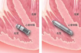 ショップ 心房リード 穿孔